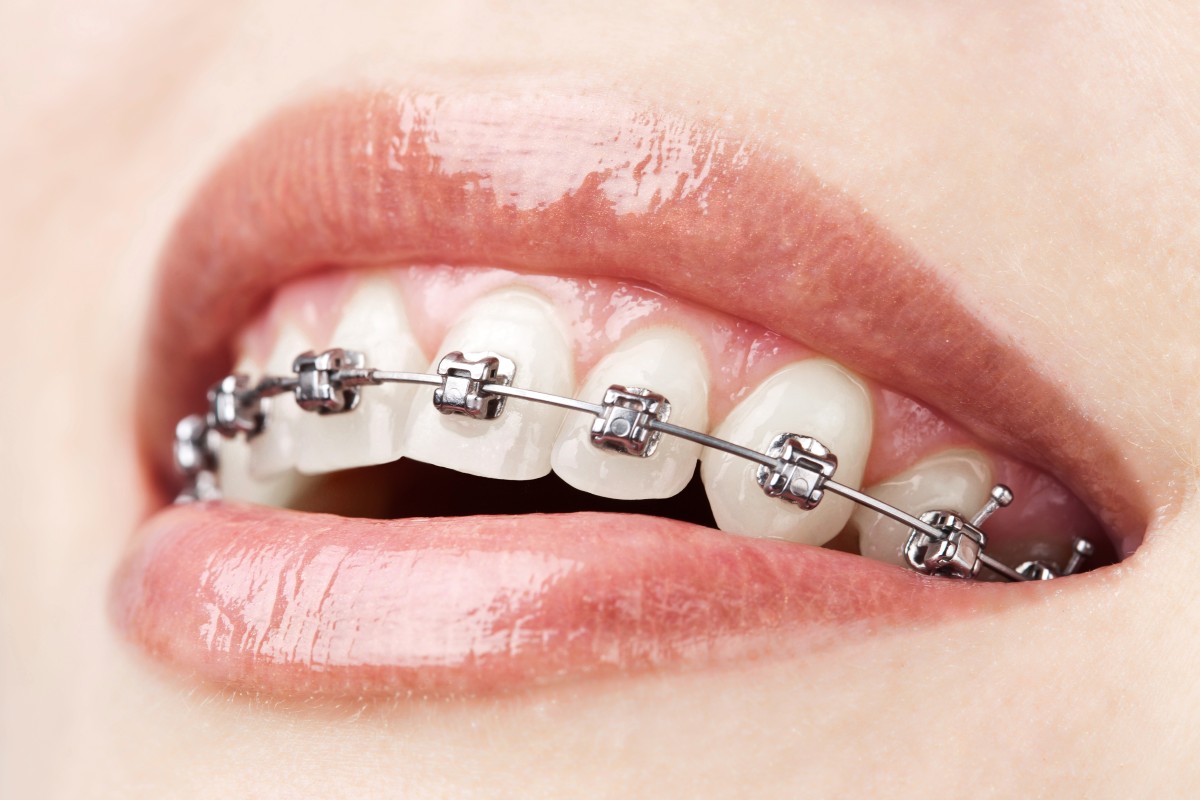 Hình ảnh cấy ghép răng implant nha khoa